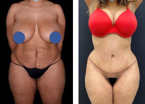 Tummy Tuck 11
