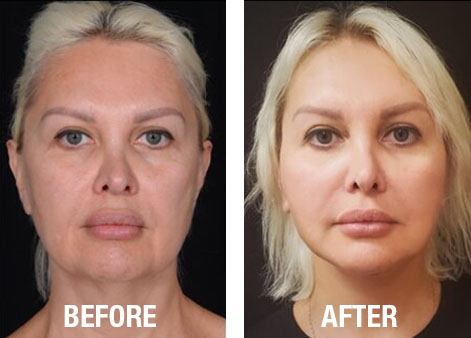 Face-Before-After-14