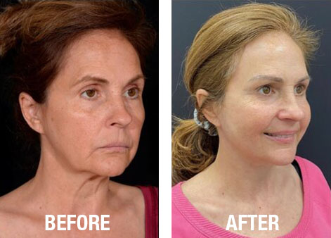 Face-Before-After-18