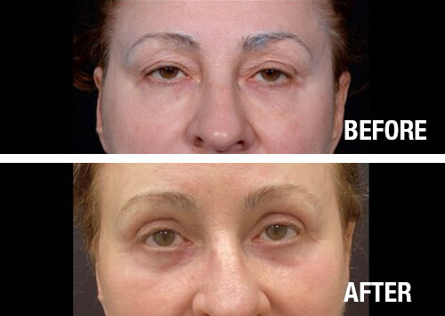 Eyelid-Surgery-Before-After-2