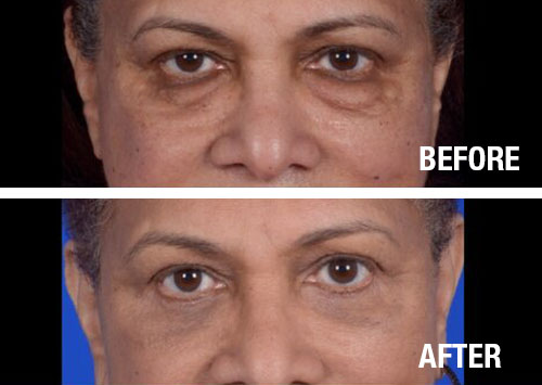 Eyelid-Surgery-Before-After-3