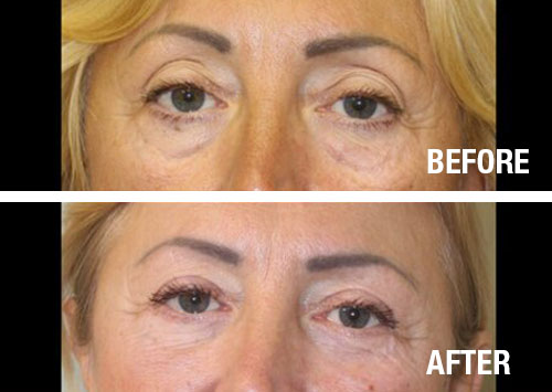 Eyelid-Surgery-Before-After-4
