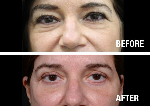 Eyelid-Surgery-Before-After-5