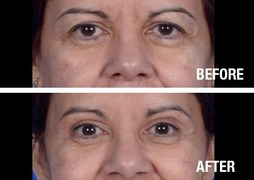 Eyelid-Surgery-Before-After-6