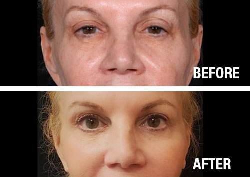 Eyelid-Surgery-Before-After-7