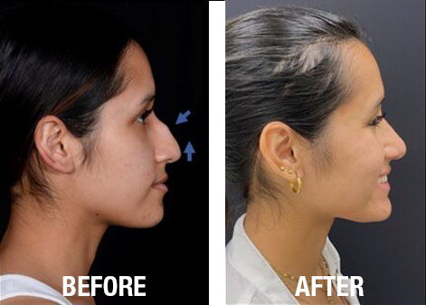 Rhinoplasty-Before-After-10
