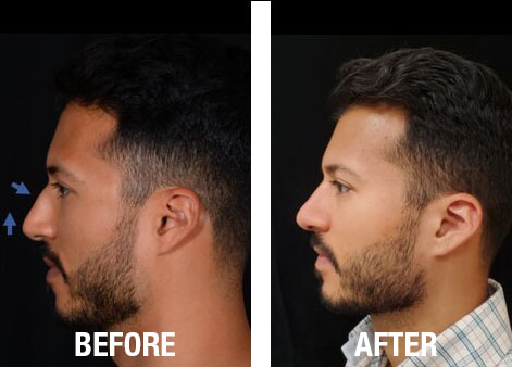 Rhinoplasty-Before-After-10