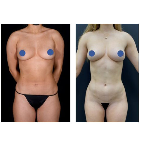 body-controuring-before-after-2