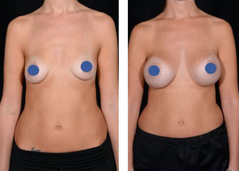 breast-before-after-7